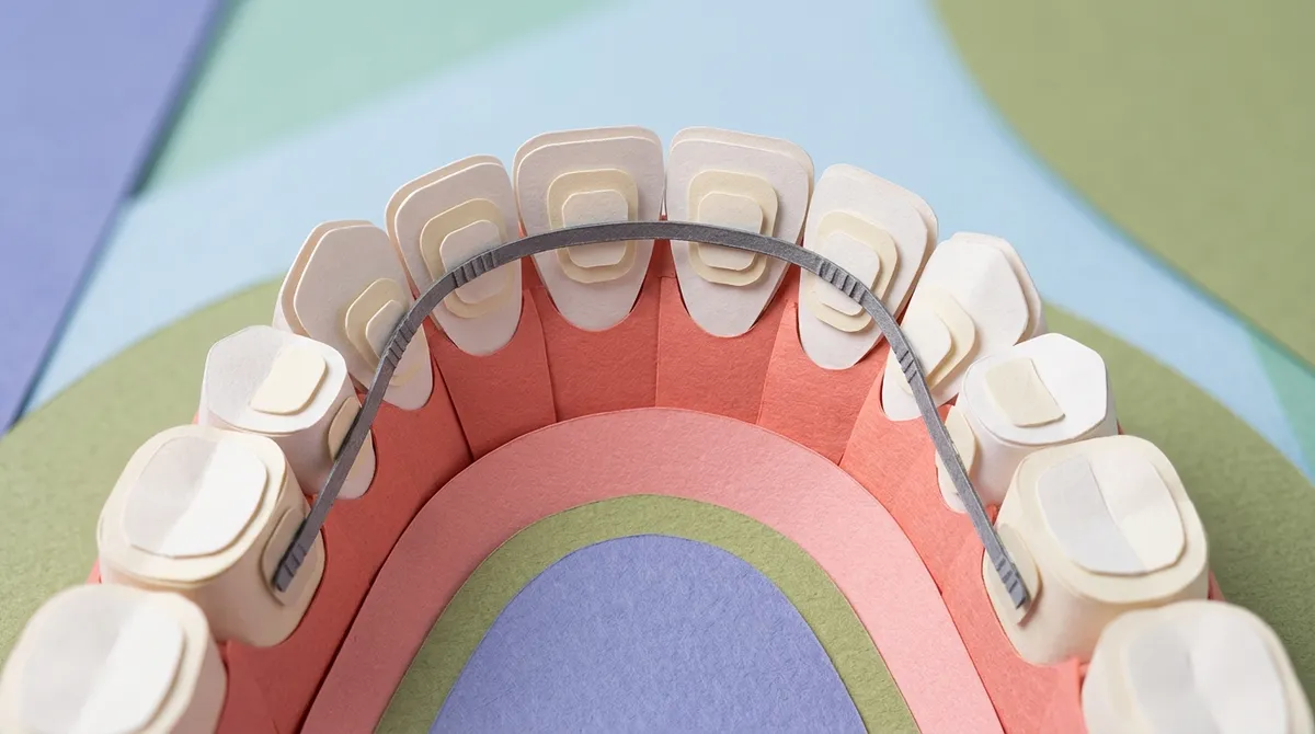 fixed retainers