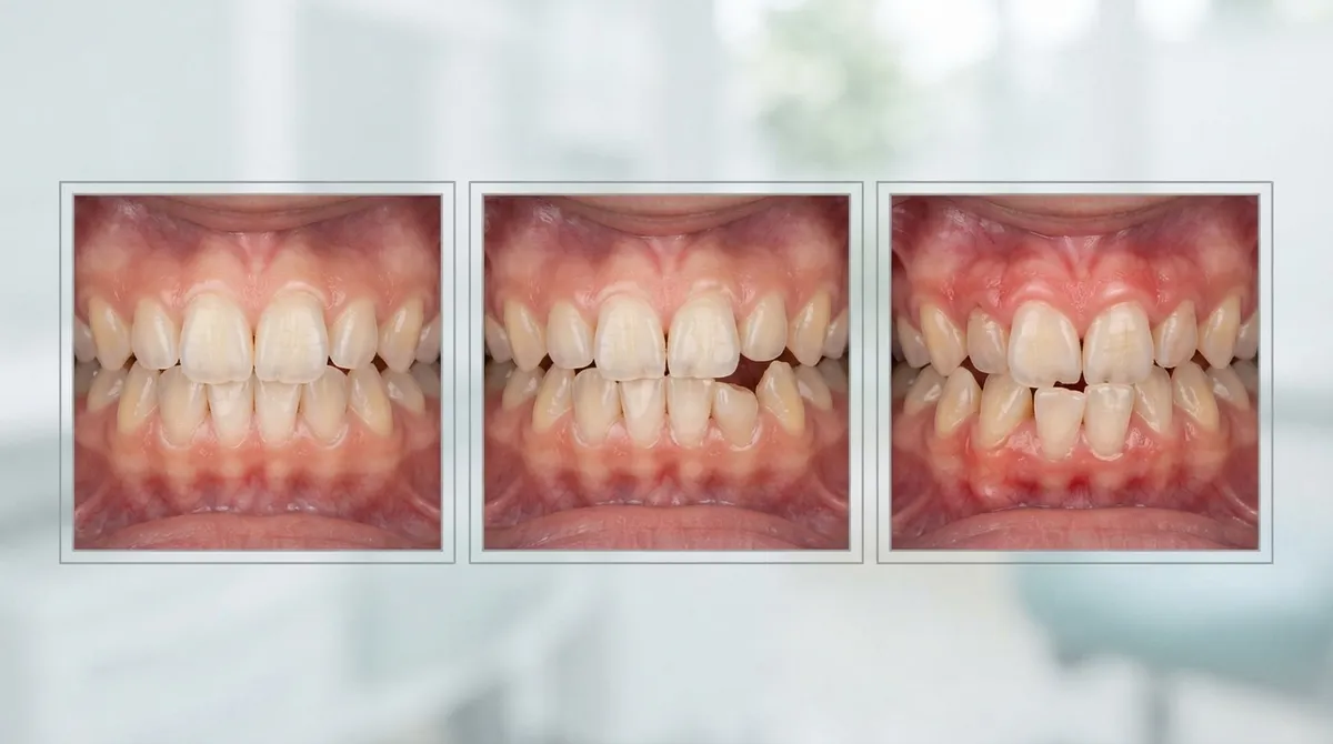 orthodontics for crowded teeth