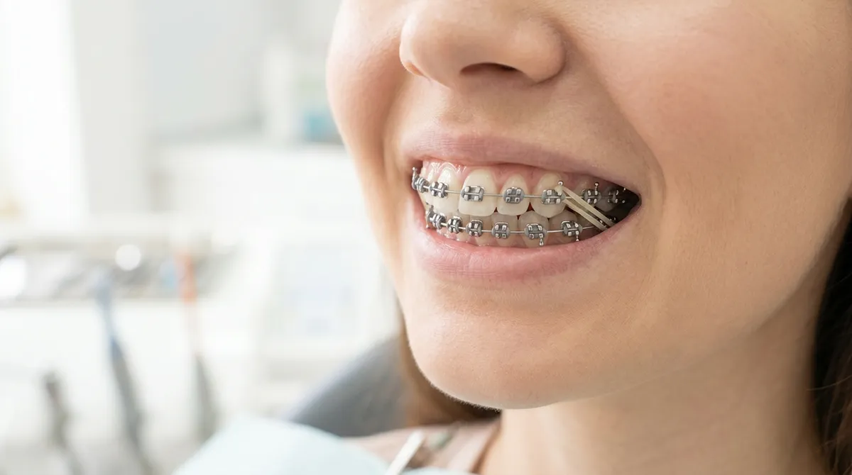 overbite treatment