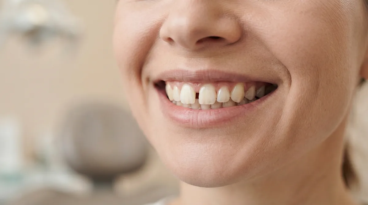 gap teeth correction